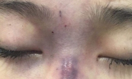 Chồng tiêm filler làm mù mắt vợ