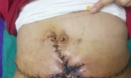 Hoại tử nặng vì hút mỡ bụng giảm béo