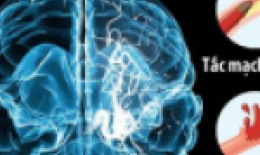 TAI BIẾN MẠCH MÁU NÃO – NGUY HIỂM KHÓ LƯỜNG