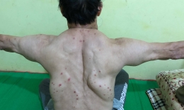 Uống rượu nhiều năm, 3 người đàn ông mắc bệnh lạ, khối u khủng mọc chi chít