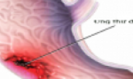 Viêm loét dạ dày - tá tràng dễ dẫn đến UNG THƯ