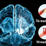 TAI BIẾN MẠCH MÁU NÃO – NGUY HIỂM KHÓ LƯỜNG