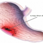 Viêm loét dạ dày - tá tràng dễ dẫn đến UNG THƯ