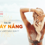 3 bí quyết làm trắng da mặt bị sạm nắng