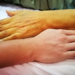 20 dấu hiệu cảnh báo từ gan bạn cần biết