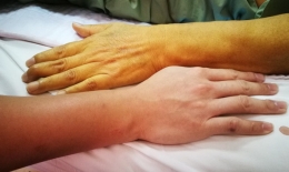 20 dấu hiệu cảnh báo từ gan bạn cần biết