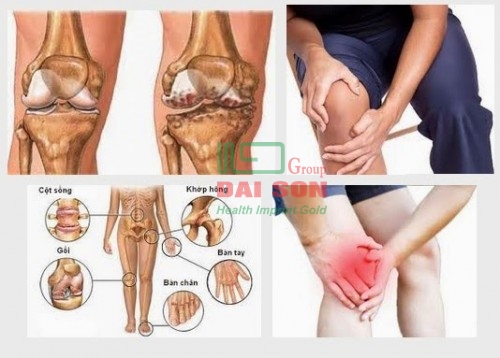 Các bệnh xương khớp thường gặp nhất hiện nay - Ảnh 1